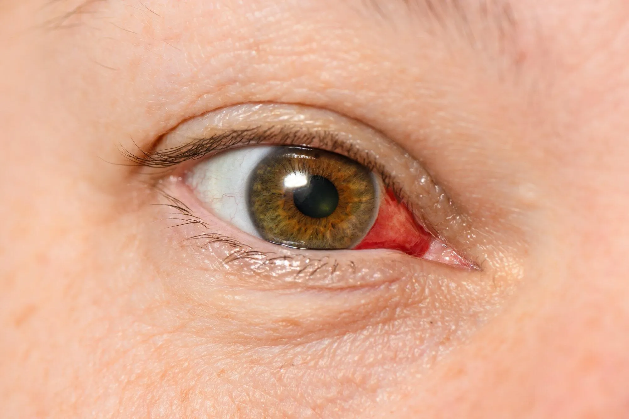 corneal abrasion vs ulcer