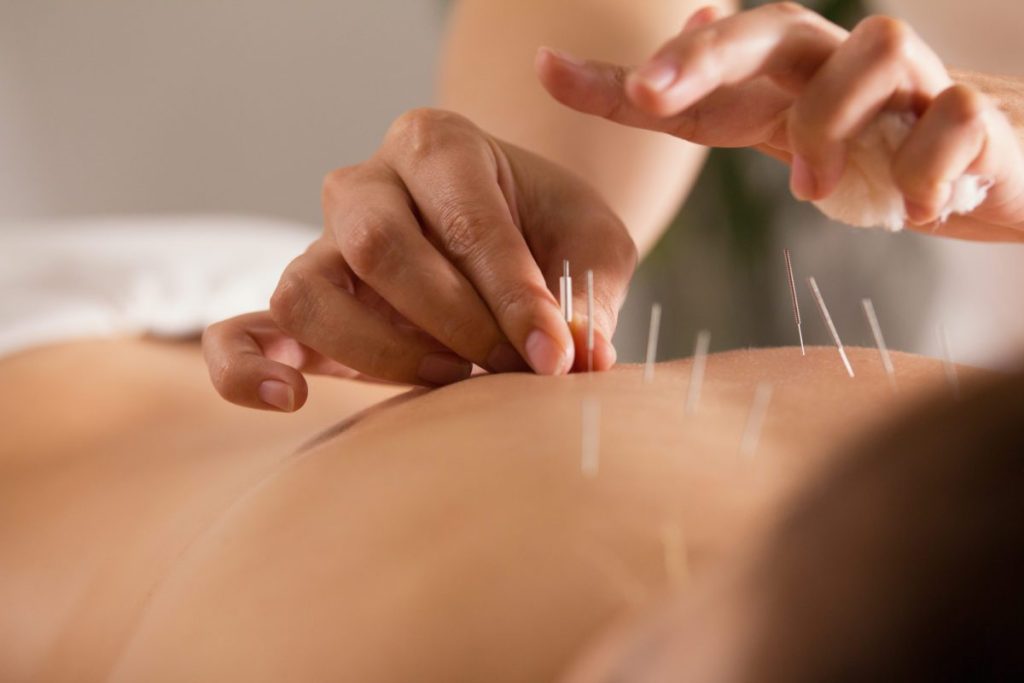 The doctor sticks needles into the girl's body on the acupuncture, close-up view